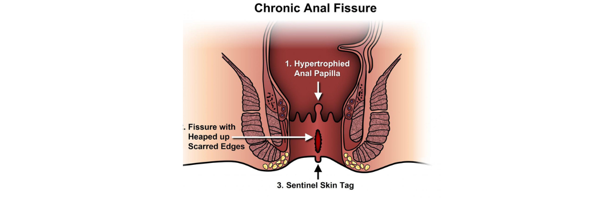 Anal Fissure Awareness